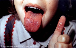 hand foot and mouth disease in mouth