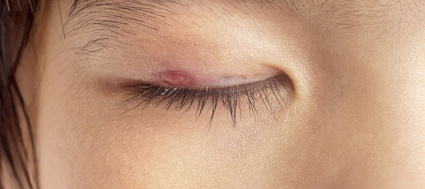 Eyelid blister on sale