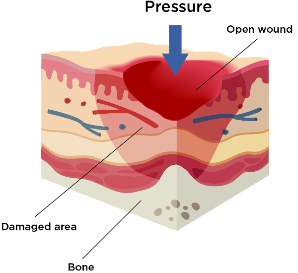 Stage 2 of pressure injury