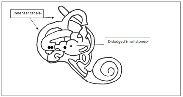 BPPV can be caused by head trauma. 