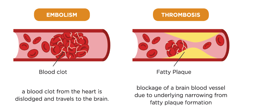 World Thrombosis Day on X: Some strokes are #embolic, blood clots starting  in one place and traveling to the brain. #WorldStrokeDay #strokechat   / X