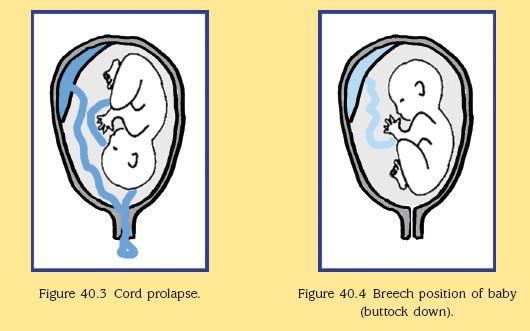 Why Doctors Perform C-Sections for Babies in Breech