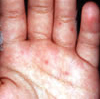 Symptoms of Hand, Food and Mouth Disease