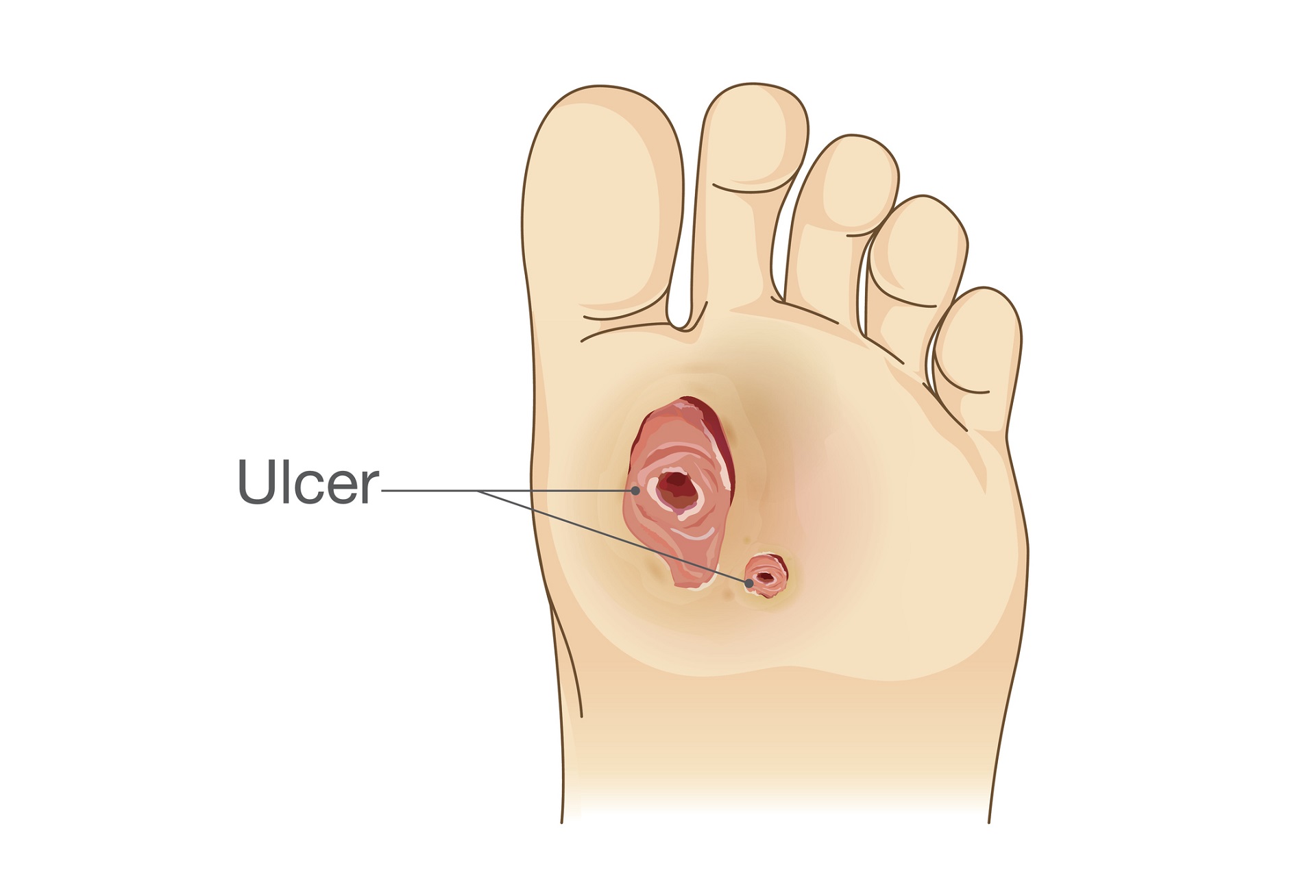 Diabetic Foot Ulcer Symptoms and Treatment