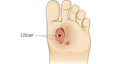 iStock-diabetic-foot-ulcer.jpg