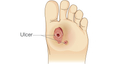Diabetic ulcers often form on the feet or legs