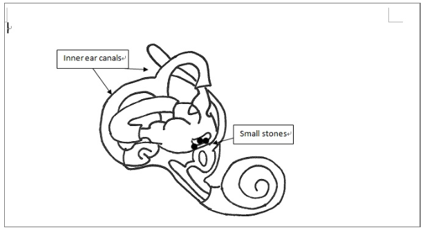 Head movements might worsen BPPV symptoms