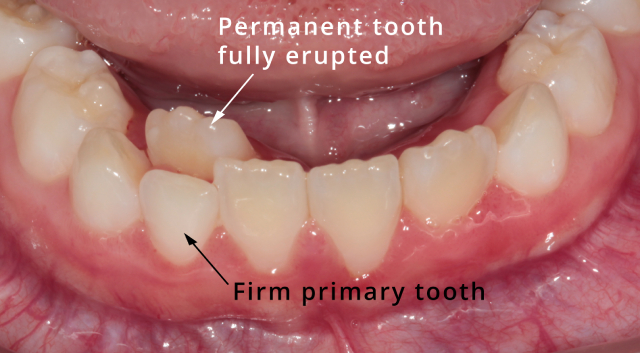 A child with both milk teeth and permanent teeth. A situation which warrants a check-up and possible extraction of a firm milk tooth.