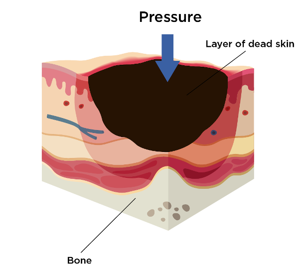 Unstageable of pressure injury