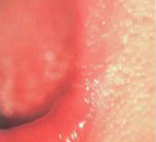 Fordyce glands appear as lip and mouth sores and are generally harmless. 