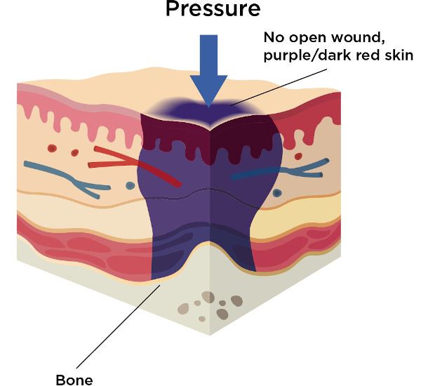 Deep tissue of pressure injury