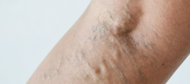 When to Worry About Varicose Veins: Symptoms & Treatment