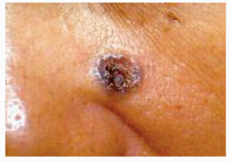 Elderly skin conditions like basal cell carcinomas is a slow-growing cancer.