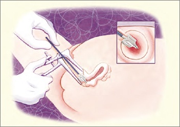 Pap Smear Illustration