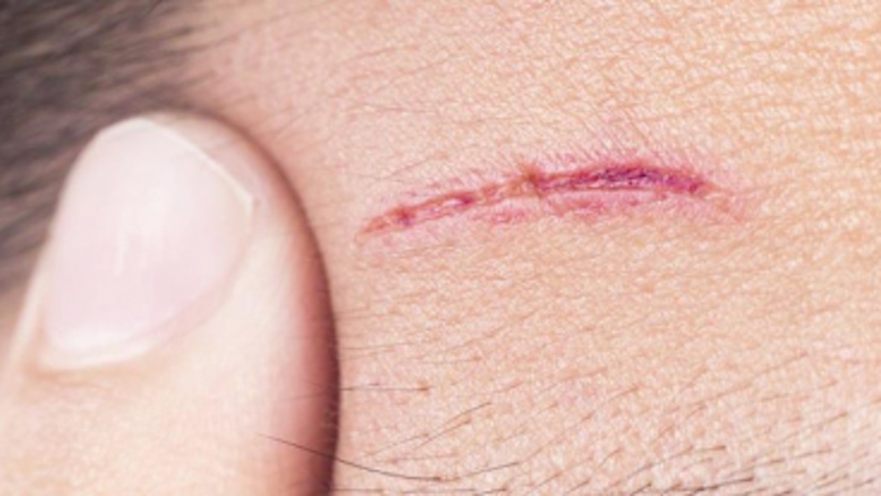 Close-up of a forehead with a small cut.