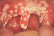 Children and adults can suffer from mouth ulcers.