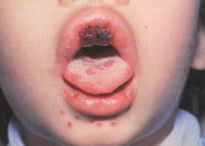 Lip sores may be caused by viral infections.