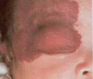 Large, red, soft growth on the eyelids.