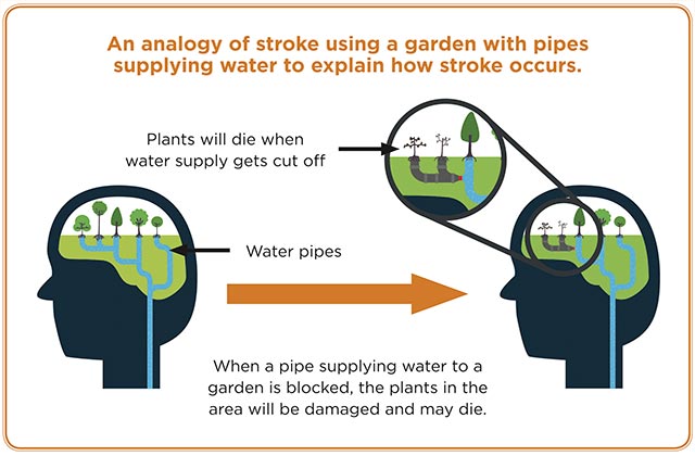 About Stroke