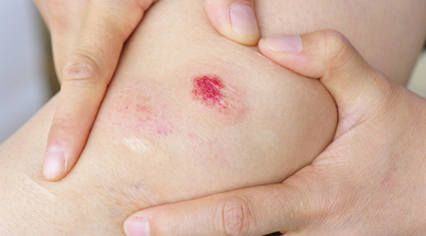 bruised_knee.jpg